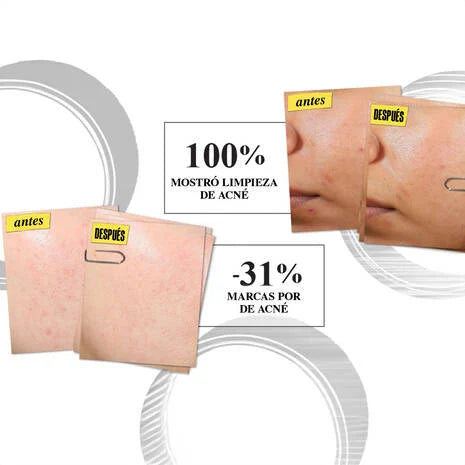 Kiehl's Expertly Clear Acne Treating y Preventing Lotion 60 ml